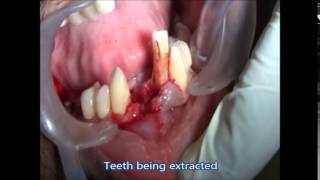 Teeth Replacement in Chennai | Dental Implant in India