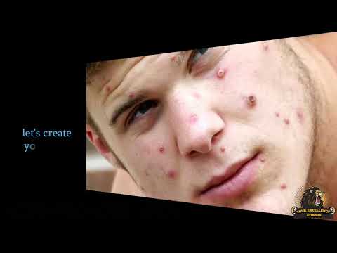 Documentary on MonkeyPox, #monkeypoxcase #monkeypoxtreatment