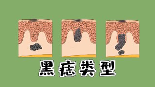 医学漫画 | 黑痣，哪些会恶变为皮肤癌？Medical Comics | Moles,segment naevus which ones can become skin cancer?