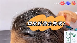 疫苗打針就聽得多拉，「頭皮針」💉你有無聽過？適唔適合你？入黎睇睇我地既介紹拉🤓