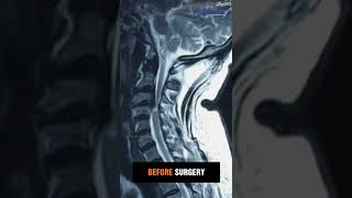 Before and After Spine Surgery #spinesurgery #surgery #backpain #spinesurgeon #backpaintreatment