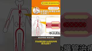 【血管硬化有哪些治療方式呢？】#血管硬化 #體外反搏系統 #血液循環 #手術善其事 #黃兆康醫師