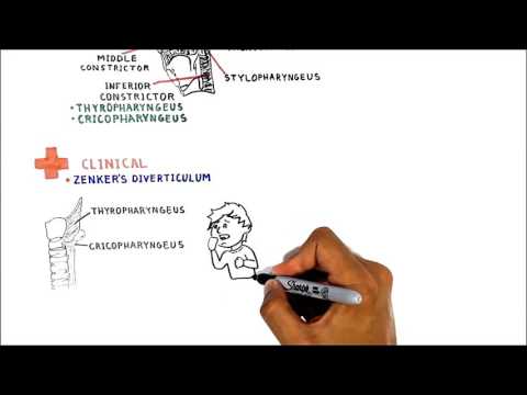 Zenker's diverticulum