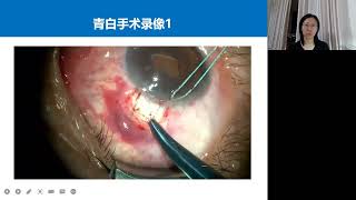 演讲：再谈青白联合术