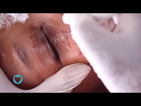 Doctors warn people to observe skin tags