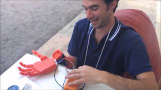 3D Printed Bionic Hands in Action