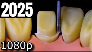 All Ceramic Crown Preparation For Upper Central (Maxillary) Incisor.