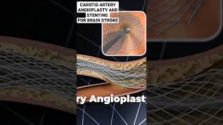 TREATMENT OF BRAIN STROKE | PREVENTION OF BRAIN STROKE | CAROTID ARTERY ANGIOPLASTY & STENTING |