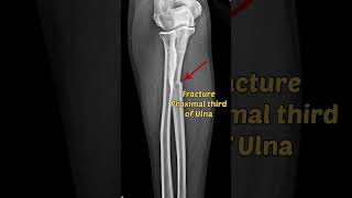 Forearm Fracture Xray | Radiology #shorts #radiology #fracture