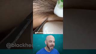 Lift an eyebrow if you have blackheads like this👀 (credit: @blackheadspopping1 on TT) #blackhead