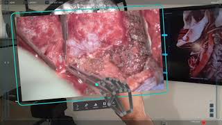 Medivis SurgicalAR: Real-Time Streaming with Augmented Reality