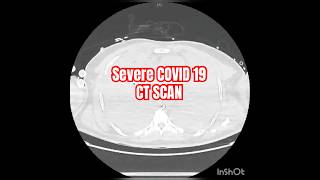 CT Scan Analysis in COVID-19: What the Images Reveal
