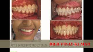 SMILE MAKE OVER ZIRCONIUM CROWNS ROOT CANAL TREATMENT SMILE DESIGNING VK DENTAL KONDAPUR LINGAMPALLI