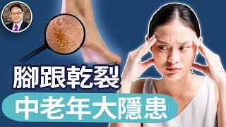 不要輕視腳跟乾裂，可能有大隱患，中老年人雙腳跟乾裂的原因與解決方法｜四維健康