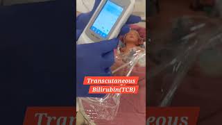 #shorts #tcb #bilirubin #jaundice #shortvideo #nicu #neonate #cute #cutebaby #neonatology #ytshorts
