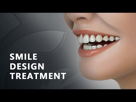 SMILE DESIGN TREATMENT