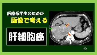 【医療系学生】 肝細胞癌