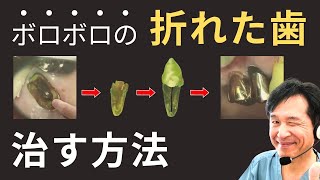 【ボロボロの折れた歯治す⁉︎】希少症例の破折歯接着治療を歯医者が見せます！！