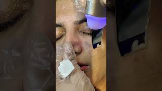 What does a Hydra facial do? - Hydrafacial Step By Step Procedure