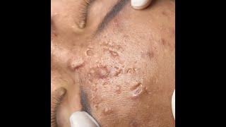 Blackhead removal,088, whitehead,pimple,acne,#blackheads , #acne ,#pimple ,#acnetreatment ,#asmr,#