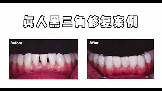 牙齿矫正必看：牙齿出现“黑三角”？别急着崩溃，看看怎么补救！