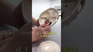 #神秘的大脑 一个视频带大家了解下颅底的世界 #颅底  #微创神经外科张教授 #抖出健康知识宝藏 #医疗健康创作训练营