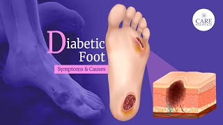 Diabetic Foot: Causes, Symptoms, Treatment and Care | CARE Hospitals