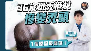 36歲港女慘變禿頭 1個原因最關鍵！一片拆解斑禿黃金治療期 中藥內外處方治脫髮 鬼剃頭｜健康嗎‪@HealthCodeHK【Chat醫D】#脫髮 #hair