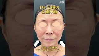 【糸リフト】【若返り】若返りならDr.島田にお任せを！