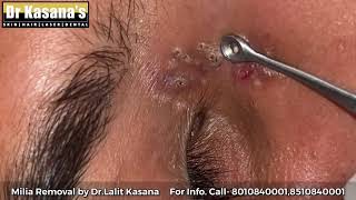 Blackheads & Milia Removal by Dr.Lalit Kasana