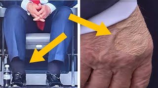 Trump's health GOES VIRAL, swollen ankles & bruises
