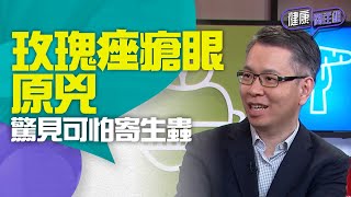 健康關注組｜ EP109 Part2｜ 玫瑰痤瘡眼原兇 驚見可怕寄生蟲 ｜ 玫瑰痤瘡 ｜ 玫瑰痤瘡眼 ｜蠕形蟎蟲 ｜ 醫學 ｜ 健康 ｜ 敖嘉年 ｜ 黃芳雯 ｜ HOY TV 77台