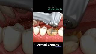 Dental Crown | Zirconia Teeth Crown | Tooth Cap.