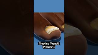 Treating troubled toenails (3D Animation)