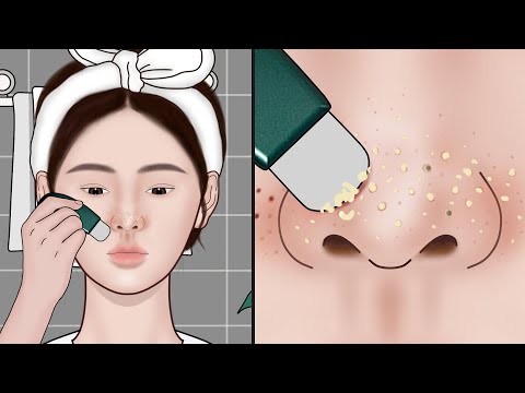 How to Remove Blackheads at Home? ASMR Blackhead Removal Animation | Meng's Stop Motion
