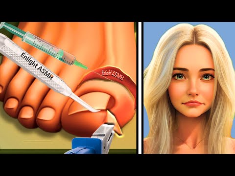 Ultimate Ingrown Toenail Removal | Satisfying ASMR Animation