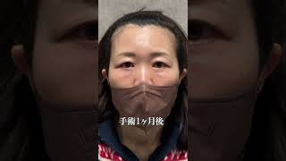 【クマ治療】整形失敗！？#クマ取り #美容整形 #目の下のクマ取り #shorts