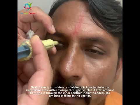 Artificial eye making| Prosthetic eye| Eye impression #prostheticeye #losteye #artificialeye