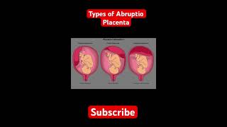 Abruptio Placenta | Types | #obg #obstetricsandgynaecology #obgclasses #obstetrics #gynecology