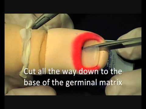 ingrown Toenail Removal Technique