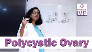 PCOS Explained: Causes, Symptoms & Treatment | Women's Health Guide | Dr Padmaja  | Medcyivf