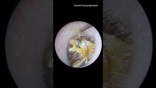 How hard ear wax is cleaned out #shorts