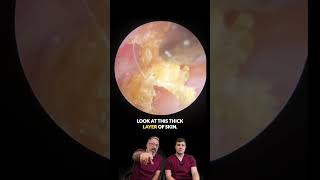 Patient Begs to Stop Ear Treatment 😱 Satisfying Wax & Skin Removal