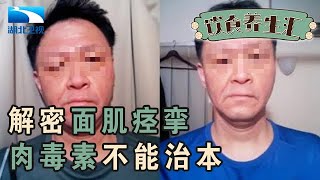 面肌痉挛有这几个发病原因,根源在脑部神经,传闻中的肉毒素并不能根治【饮食养生汇】