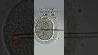 injecting a sperm into a human egg to overcome infertility
