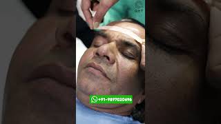 Rajpal Yadav Hair Transplant Result | Latest Fue Technique #shorts #viral #hair transplant