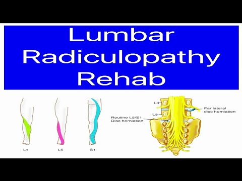 Lumbar Spine Rehab: Radiculopathy Sciatica, Lumbar Nerve Root Compression, LOWER BACK and LEG PAIN