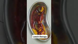 Leech Therapy Treatment in Ranchi 9204900900 |  Leech Therapy | Kerala Ayurveda  #leechtherapy