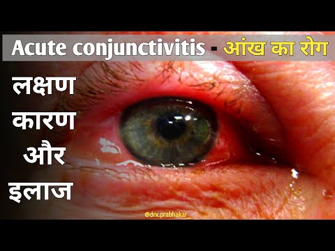 Conjunctivitis treatment in hindi | Eye inflammation Treatment | Moxifloxacin Eye drop & it's uses