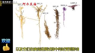 有读 阿尔茨海默病在两个不同阶段损害大脑
